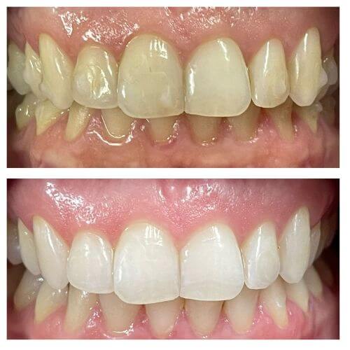 Clareamento dental com LED Violeta: resultado do trabalho da Dra. Alessandra Marques dentista em Campinas especialista em odontologia estética clareamento dental com LED Violeta e facetas de porcelana