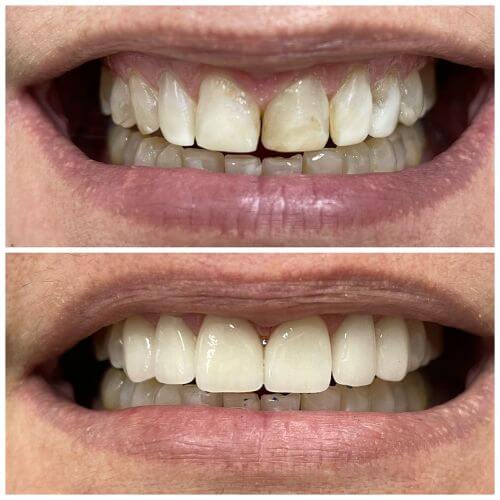 Facetas de Porcelada: resultado do trabalho da Dra. Alessandra Marques dentista em Campinas, especialista em odontologia estética clareamento dental com LED Violeta e facetas de porcelana