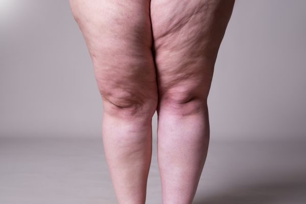 Lipedema Obesidade Sobrepeso